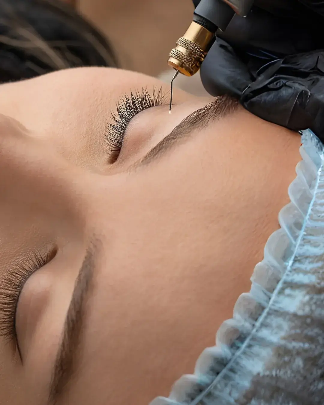 Tecnologia Plasma IQ - Plasma IQ: retração cutânea localizada para flacidez palpebral e rugas ao redor dos olhos, sem cirurgia. Avaliação em Uberlândia.